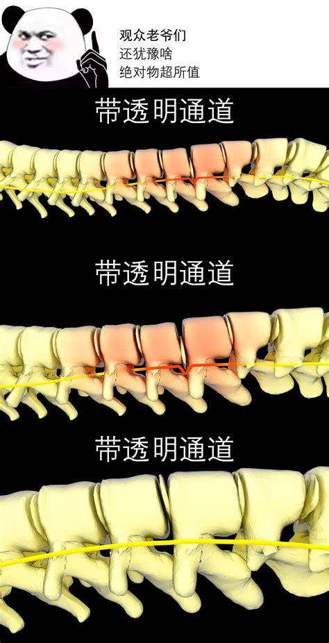 腰椎间盘突出腰椎突出脊椎康复 视频素材包下载 编号 4686488 光厂 Vj师网