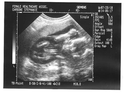 Been Given Grace Week Ultrasound Pictures