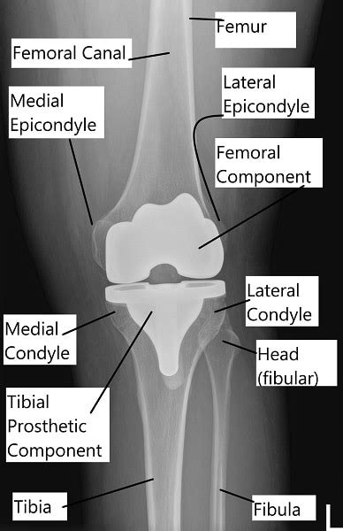 Total Knee Replacement, Knee Specialist in NY | Complete Orthopedics