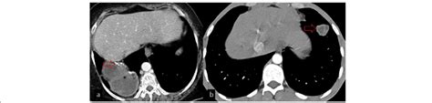 A Calcification In The Wall Of The Hydatid Cyst Is Seen On The Axial Ct Download Scientific