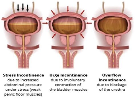 E1 Urology Urinary Incontinence Scrotal Masses Flashcards Quizlet