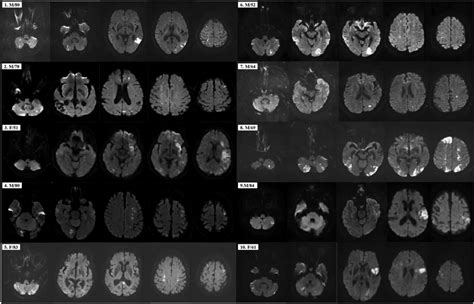 Axial Diffusion Weighted Images Of Brain Mri Show Multiple Acute Brain