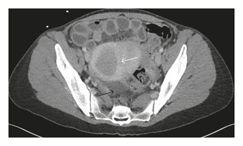 Initial Ct Scan Upon Presentation A B With Uterine Fibroids White Download Scientific