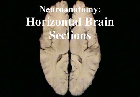 Neuroanatomy Horizontal Brain Sections Anatomy Guy