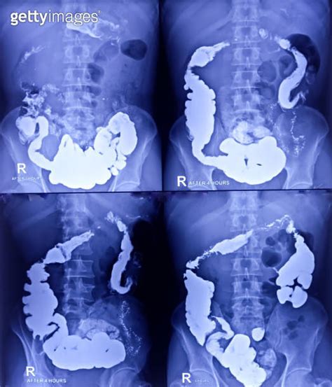 Barium Meal And Follow Through Examination X Ray Showing Digestive