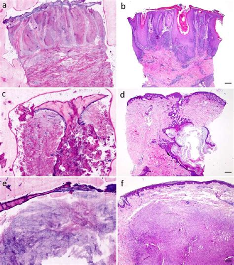 Inflammatory Dermatoses Cysts And Other Tumors A Lichen Planus