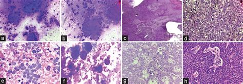 Cytomorphology Of Skin Adnexal Tumors And Its Correlation With