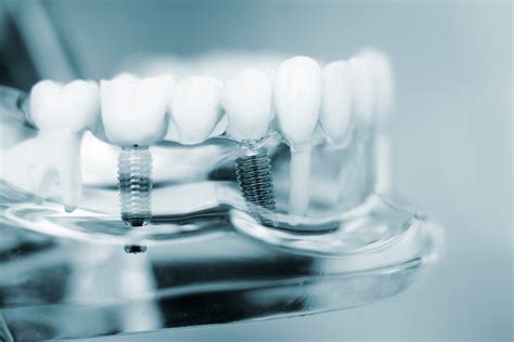 What Are Dental Implants Made Of Westport Ct