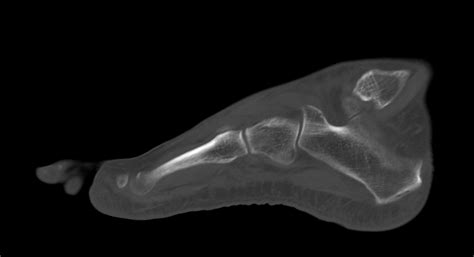 Anterior Calcaneal Process Fracture Image Radiopaedia Org