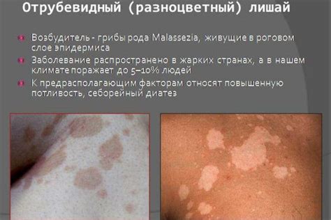 Отрубевидный лишай (разноцветный, цветной): лечение и причины появления