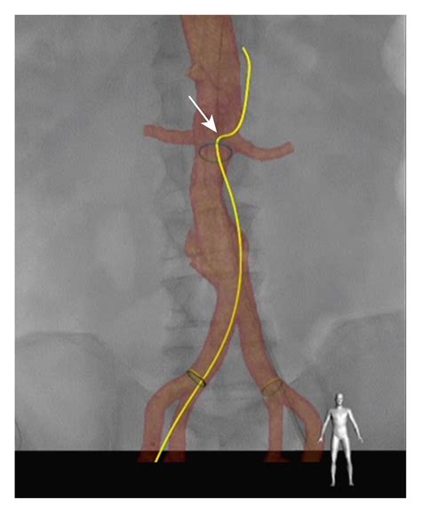 First In Human Clinical Feasibility Study Of Endovascular Navigation