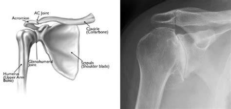 Understanding Shoulder Arthritis Hofmann Arthritis Institute