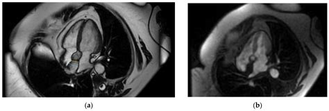 Importance Of Multimodality Cardiac Imaging In The Diagnosis Of