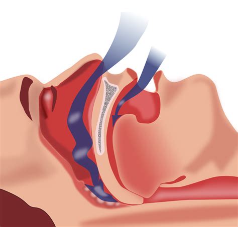 Dental Guide To Obstructive Sleep Apnea And Sleep Disordered Breathing