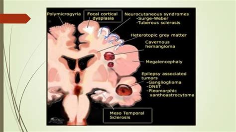 Frontal lobe epilepsy