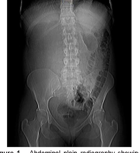 Figure From Unilateral Giant Renal Angiomyolipoma And Pulmonary