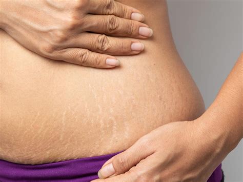 Stretch Marks स्ट्रेच मार्क्स पर अप्लाई करें ये नेचुरल इंग्रीडिएंट्स