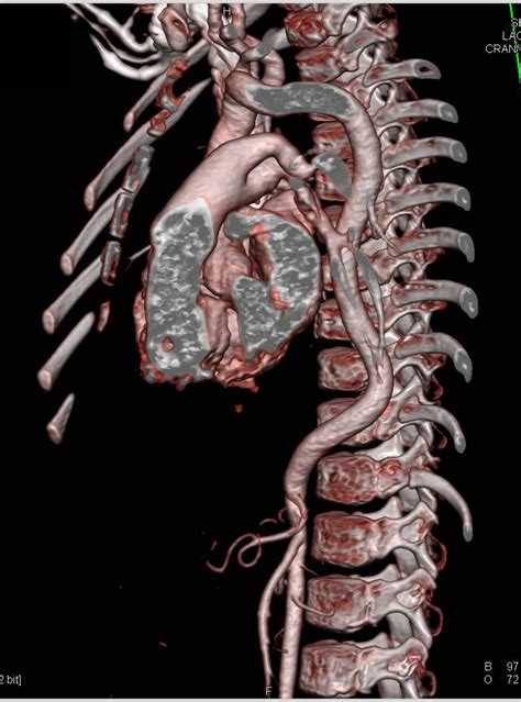 CTA in Loeys Dietz Syndrome with Vascular Tortuosity in Head and Neck ...