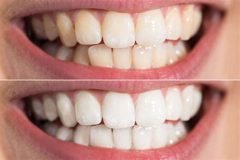 How To Fix Discolored Teeth Cosmetic Dentistry In Laurel Md