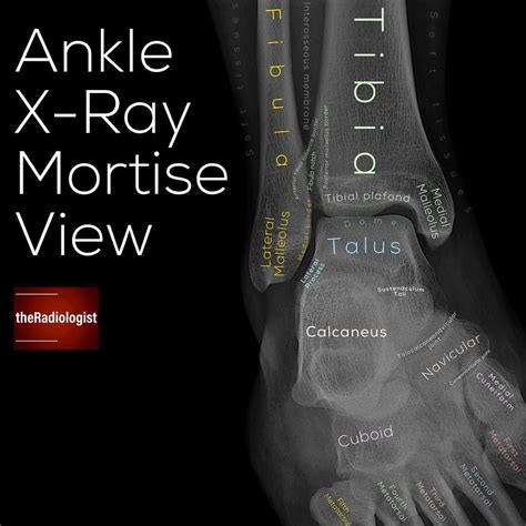 Develop A System For Reviewing The Ankle X Ray Mortise View Swipe Left For A Full Explanation