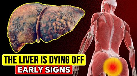 Early Signs That Your Liver Is Dying People With Liver Problems Don