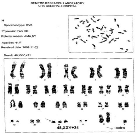 Karyotype showing 3 copies of chromosome 21, 2 copies of chromosome X ...