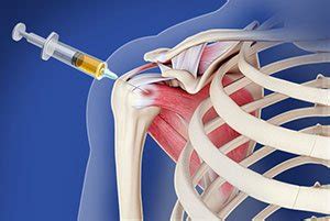 Intraarticular Shoulder Injection Centreville, VA | Shoulder Arthritis Treatment Ashburn, VA