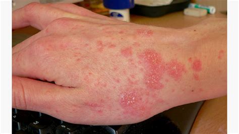 What Is The Fastest Way To Kill Scabies