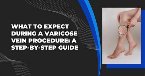 What To Expect During A Varicose Vein Procedure A Step By Step Guide