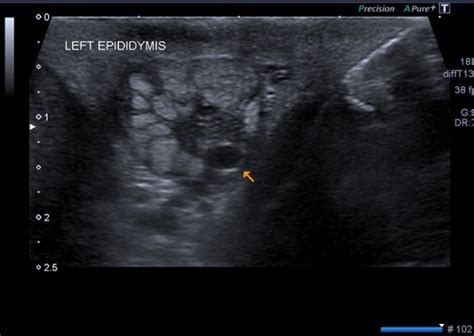 Pampiniform Plexus Ultrasound