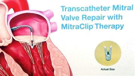 Mitral Valve Replacement In Hyderabad Without Surgery