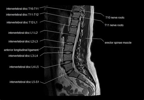 Mri Lumbar Spine Sagittal Cross Sectional Anatomy Anatomy Images Mri