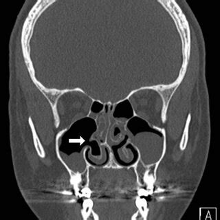 Non-contrasted paranasal sinuses CT scan, coronal view for case 1 ...