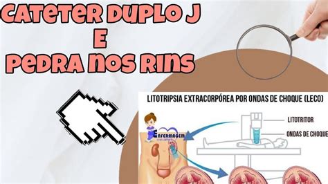 Pedras No Rim E Canal Usar Cateter Duplo J Youtube