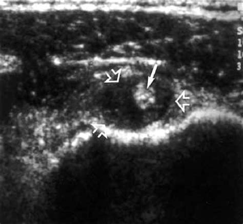 Transverse ultrasound image of the biceps tendon from a patient with ...