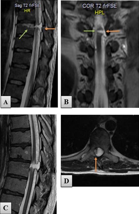 T2 Weighted MRI Scans Of The Thoracic Spine Performed Preoperatively