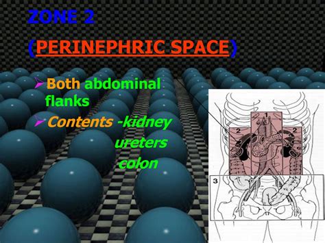 Retroperitoneal Hematoma Zones Approach Ppt Download