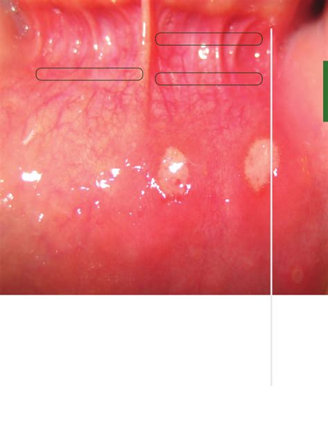 The Diagnosis And Management Of Recurrent Aphthous 43 Off