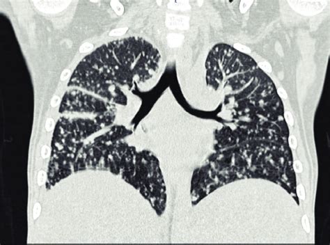 Ct Scan Of The Chest Showing Features Of Miliary Tuberculosis Download Scientific Diagram