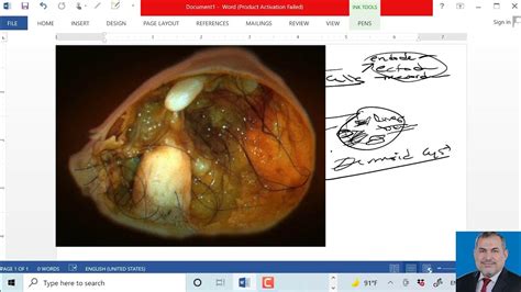 Pediatric Surgery Teratomas د عامر الخزاعي Youtube