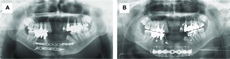 Preoperative A And Postoperative B Radiography Images Download Scientific Diagram