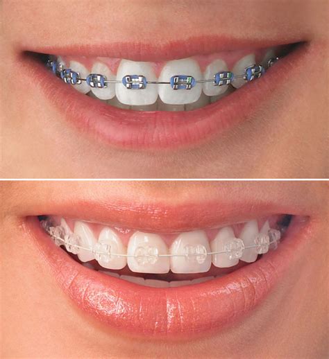 Clear Ceramic Brace Sydney Ceramic Braces Cost Smile Concepts