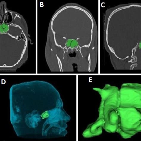 Volumetric Measurement And 3d Reconstruction Of Sphenoid Sinus With Download Scientific Diagram