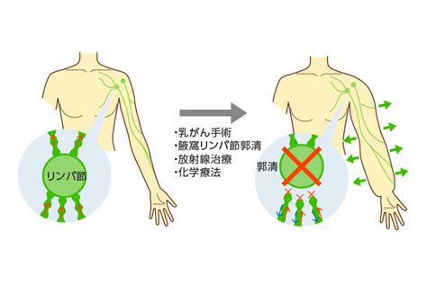 リンパ浮腫とは【大阪あべのリンパ浮腫クリニック】リンパ浮腫日帰り手術｜京都・和歌山