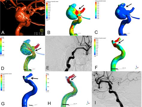 Frontiers Hemodynamic Characteristics Associated With Paraclinoid