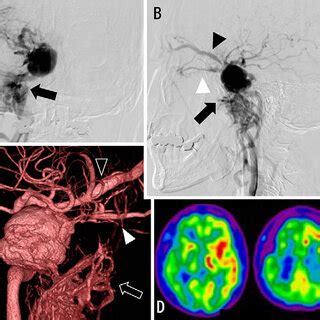 In The Anteroposterior A And Lateral B Views Of The Ica Angiogram