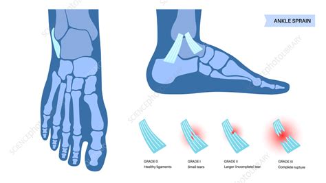 Ankle sprain injury, illustration - Stock Image - F042/1195 - Science Photo Library