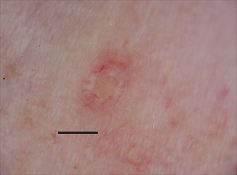 Dermoscopy Of Molluscum Contagiosum Dermatology Jama Dermatology