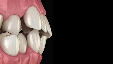 Occlusal Trauma And Periodontal Diseases Dimensions Of Dental Hygiene