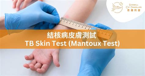TB Skin Test in Hong Kong: Everything You Need to Know for Studying ...